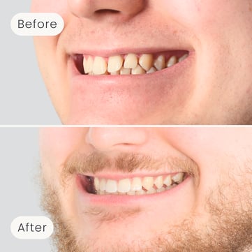 Left side profile of a Mulgrave Dental Group patient before orthodontic treatment, with large gaps between the teeth, and after, with a perfectly aligned smile.