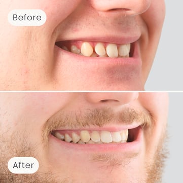 Right side profile of a Mulgrave Dental Group patient before orthodontic treatment, with large gaps between the teeth, and after, with a perfectly aligned smile.