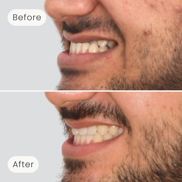 Left side profile of a Mulgrave Dental Group patient before orthodontic treatment, with a crossbite, and after, with a corrected bite and more aligned teeth.