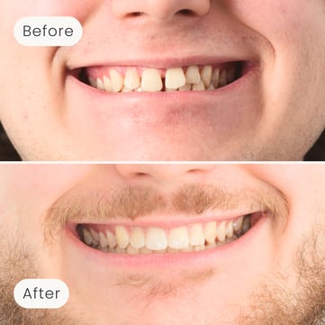 Mulgrave Dental Group patient before orthodontic treatment, with large gaps between the teeth, and after, with a perfectly aligned smile.