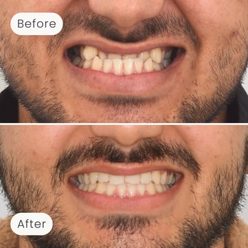 Mulgrave Dental Group patient before orthodontic treatment, with a crossbite, and after, with a corrected bite and more aligned teeth.