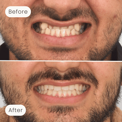 Before and after image of orthodontic treatment done by Mulgrave Dental Group, helping patients achieve beautifully aligned smiles.