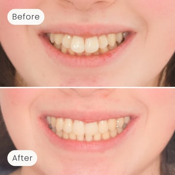 Mulgrave Dental Group patient before orthodontic treatment, with an overbite, and after, with a corrected bite and more aligned teeth.
