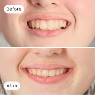 Close-up of a young Mulgrave Dental Group patient's smile showing teeth before and after orthodontics treatment, with straighter, more aligned teeth.
