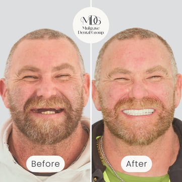 Mulgrave Dental Group patient before All-On-4 treatment, with most of their top front teeth missing, and after All-On-4 dental implants with a beautiful complete set of bright teeth.