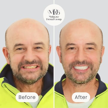 Mulgrave Dental Group patient before All-On-4 treatment, with crooked and discoloured teeth, and after All-On-4 treatment, showing a fully aligned and whiter smile.