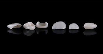 Close up of porcelain veneers.