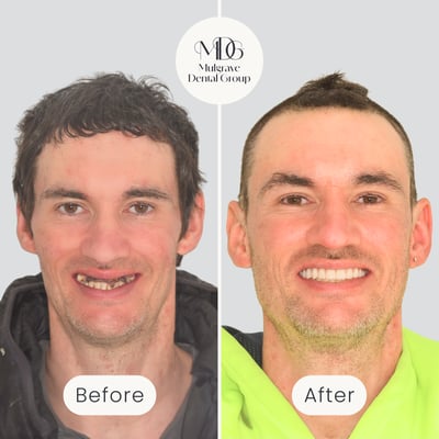 Before and after image of smile transformation after All-on-4 dental implant treatment by Mulgrave Dental Group.