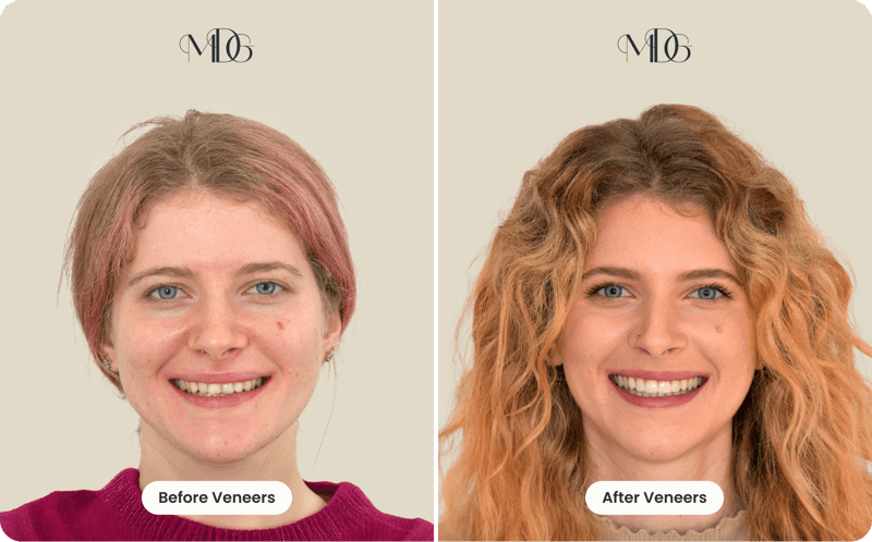 Ellen Before and After Veneers