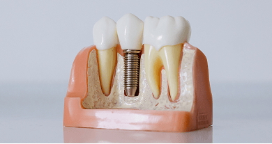 Close-up of a dental model showing a single tooth implant between two natural teeth, illustrating how the implant integrates with the jawbone to replace a missing tooth.