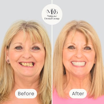 Mulgrave Dental Group patient before All-On-4 treatment, with a crossbite and discoloured teeth, and after All-On-4 treatment with a fully aligned, bright beautiful smile.