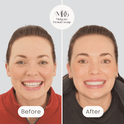 Before and after image of stunning smile transformation results with veneers by Mulgrave Dental Group.