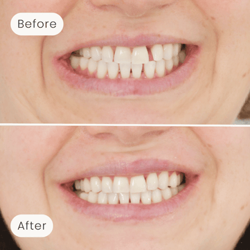 Mulgrave Dental Group patient before orthodontic treatment, with gaps between the teeth, and after orthodontic treatment, with an aligned smile and no more gaps.
