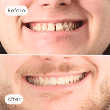 Mulgrave Dental Group patient before orthodontic treatment, with crooked teeth, and after orthodontic treatment, with an aligned smile.