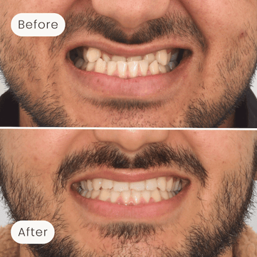 Mulgrave Dental Group patient before orthodontic treatment, with a crossbite, and after orthodontic treatment, with a corrected bite and aligned smile.