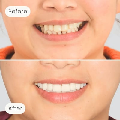 Before and after image of veneers treatment done by Mulgrave Dental Group, helping patients achieve brighter and functional smiles.