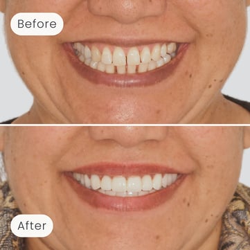 Mulgrave Dental Group patient before veneers with some discolouration and slight gaps between the teeth, and after veneers with a beautiful, perfect smile.