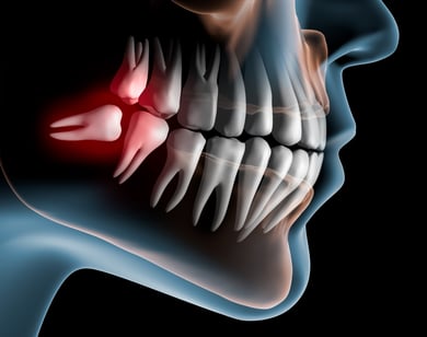 3D illustration of x-ray revealing wisdom teeth positioned at an angle.