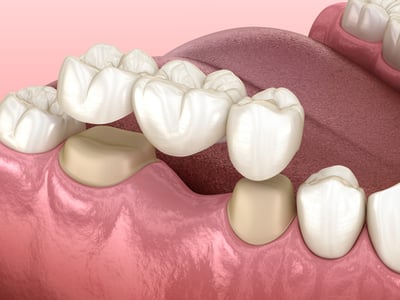 3D illustration of a dental bridge being fixed on to replace missing teeth.