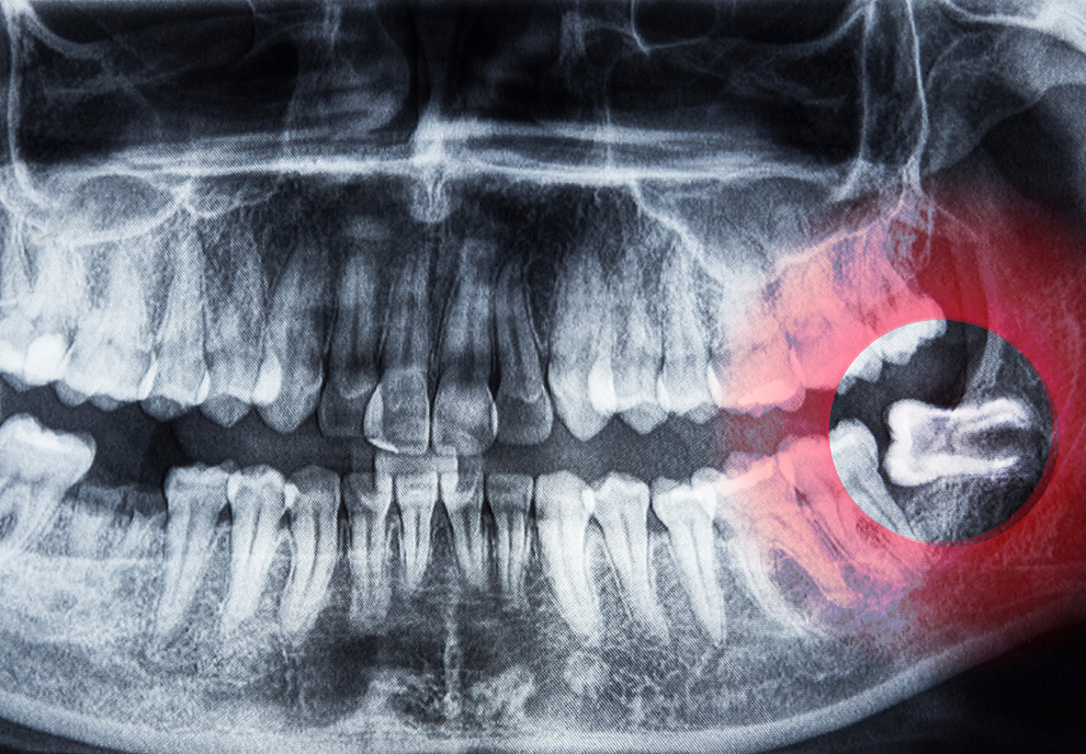 A dental X-ray showing a wisdom tooth growing sideways, pressing against the adjacent molar. The surrounding teeth and jawbone structure are clearly visible, illustrating the potential for impaction and crowding.