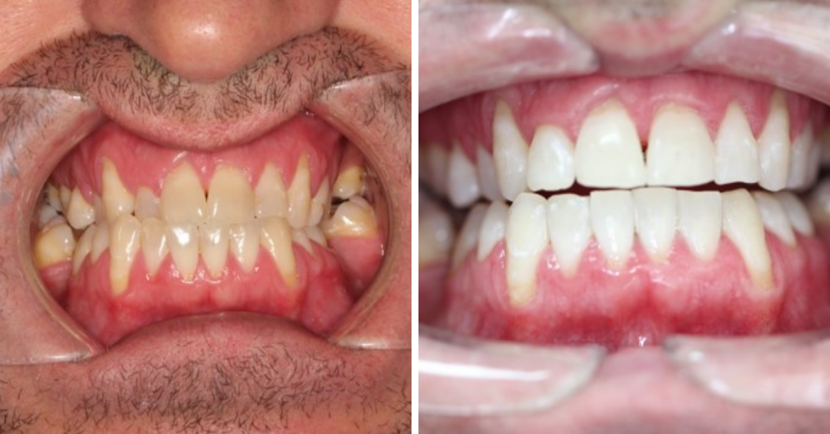 Before & After - Clear Aligners Kids