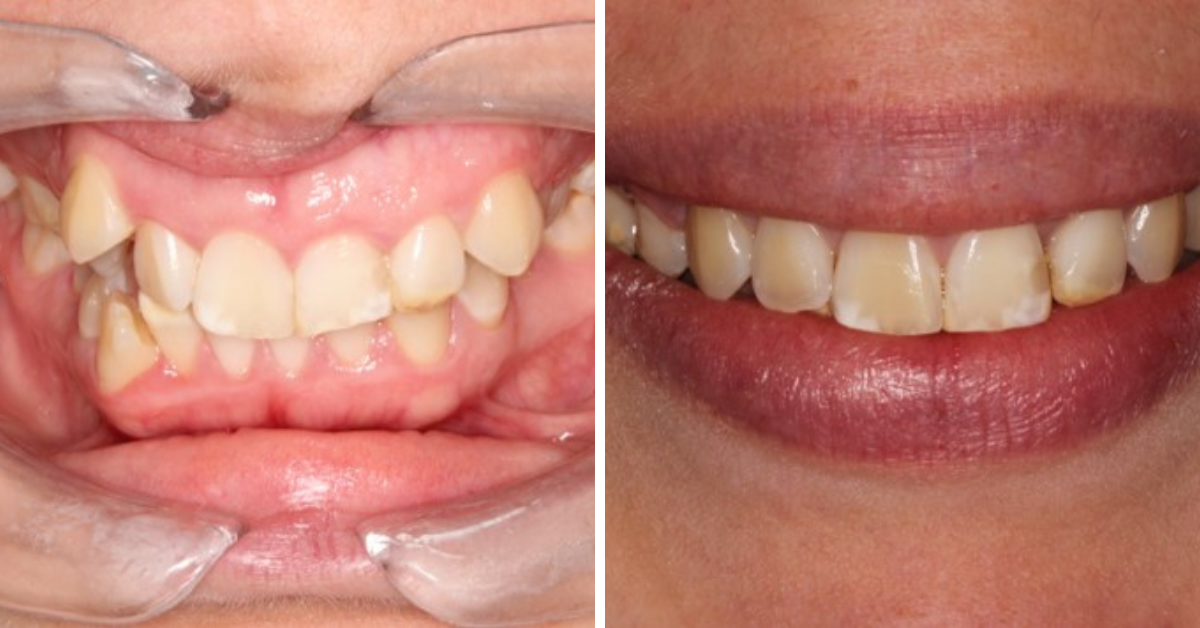 Before & After - Orthodontics Kids