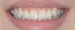 Adult 02 After - Invisalign Clear Aligners