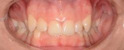 Adult 02 Before -Invisalign Clear Aligners