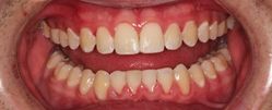 Adult 04 After - Invisalign Clear Aligners