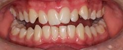 Adult 04 Before  - Invisalign Clear Aligners