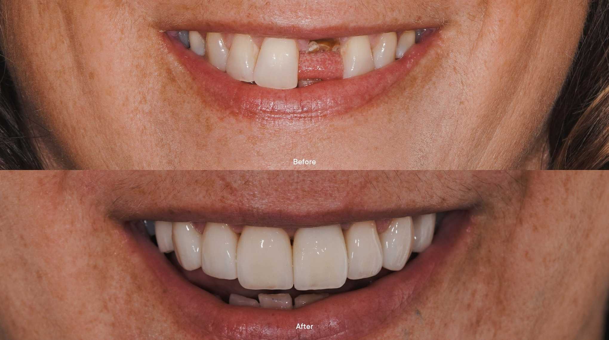 Porcelain veneers Melbourne BFT