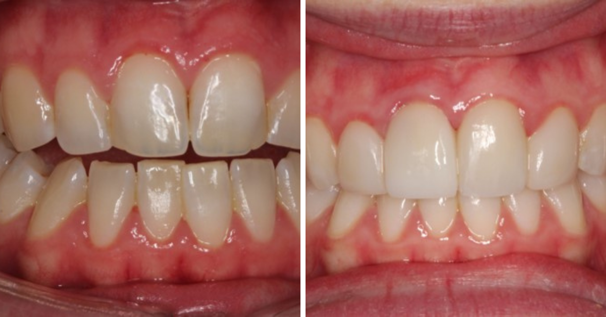 Dental Venners Mulgrave Dental Venners Mulgrave