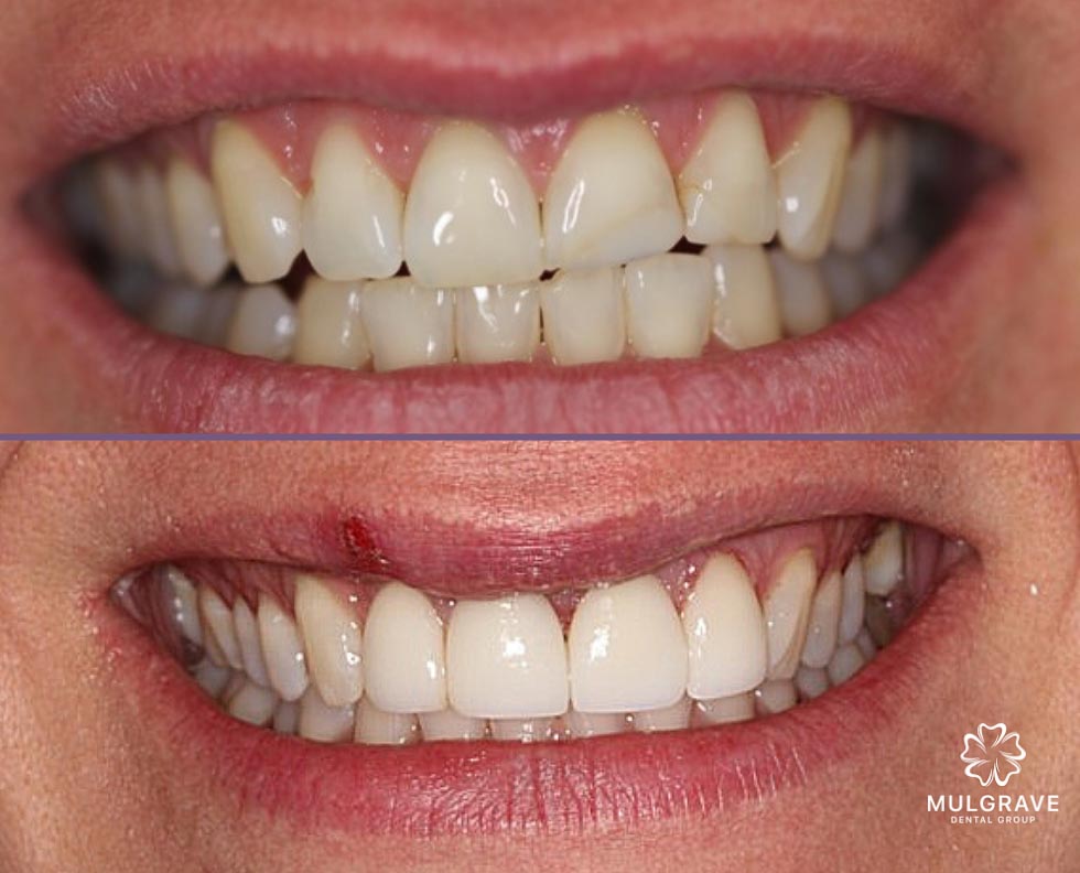 Before & After - Dental Veneers