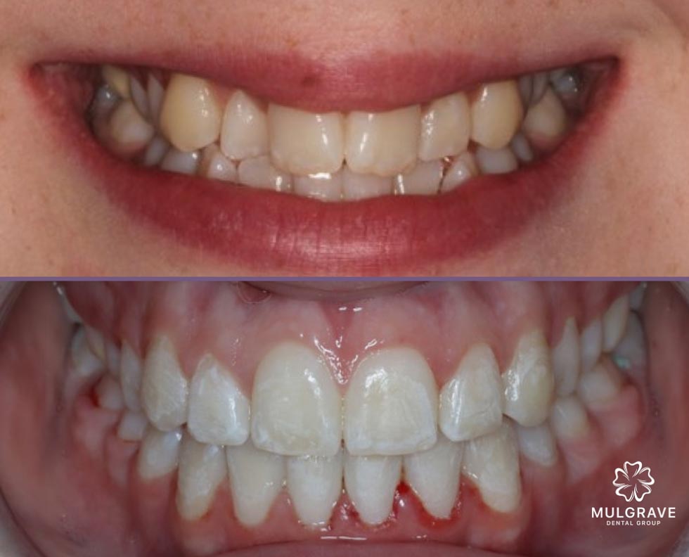 Orthodontics Result 01 Mulgrave Dental Group