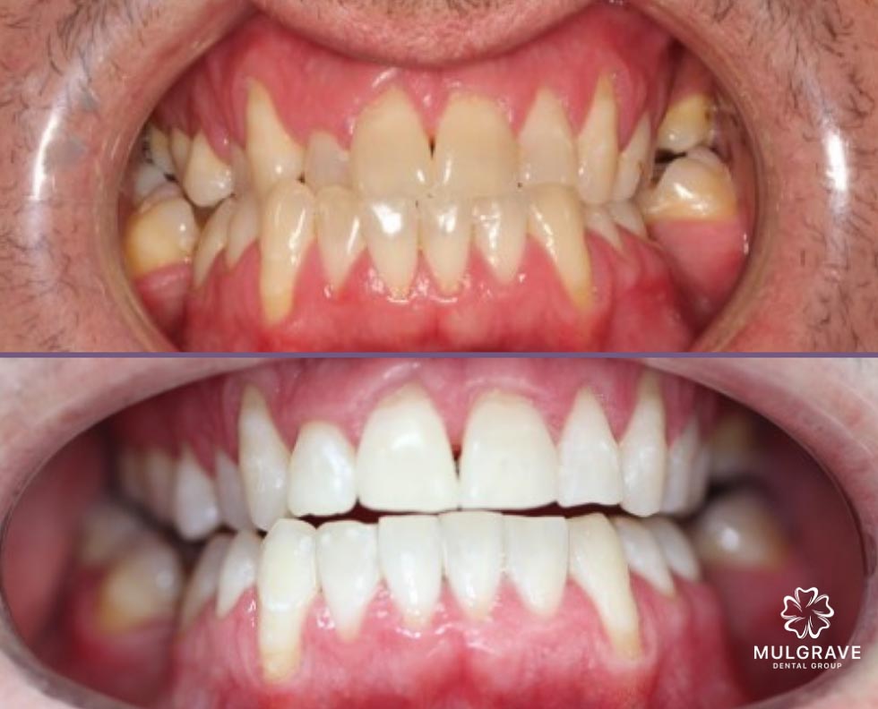 Before & After - Mulgrave Dental Group