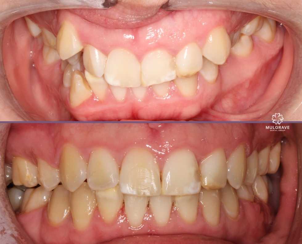 Braces by Mulgrave Dental Group Melbourne Australia Braces by Mulgrave Dental Group Melbourne Australia
