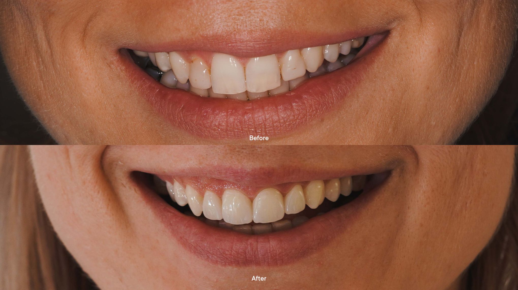 Veneer Before and After PxC-B