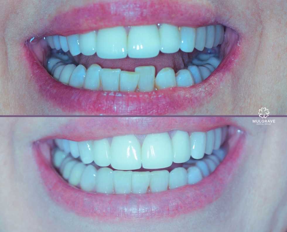 Clear aligner orthodontics by Mulgrave Dental Group Melbourne Australia Clear aligner orthodontics by Mulgrave Dental Group Melbourne Australia