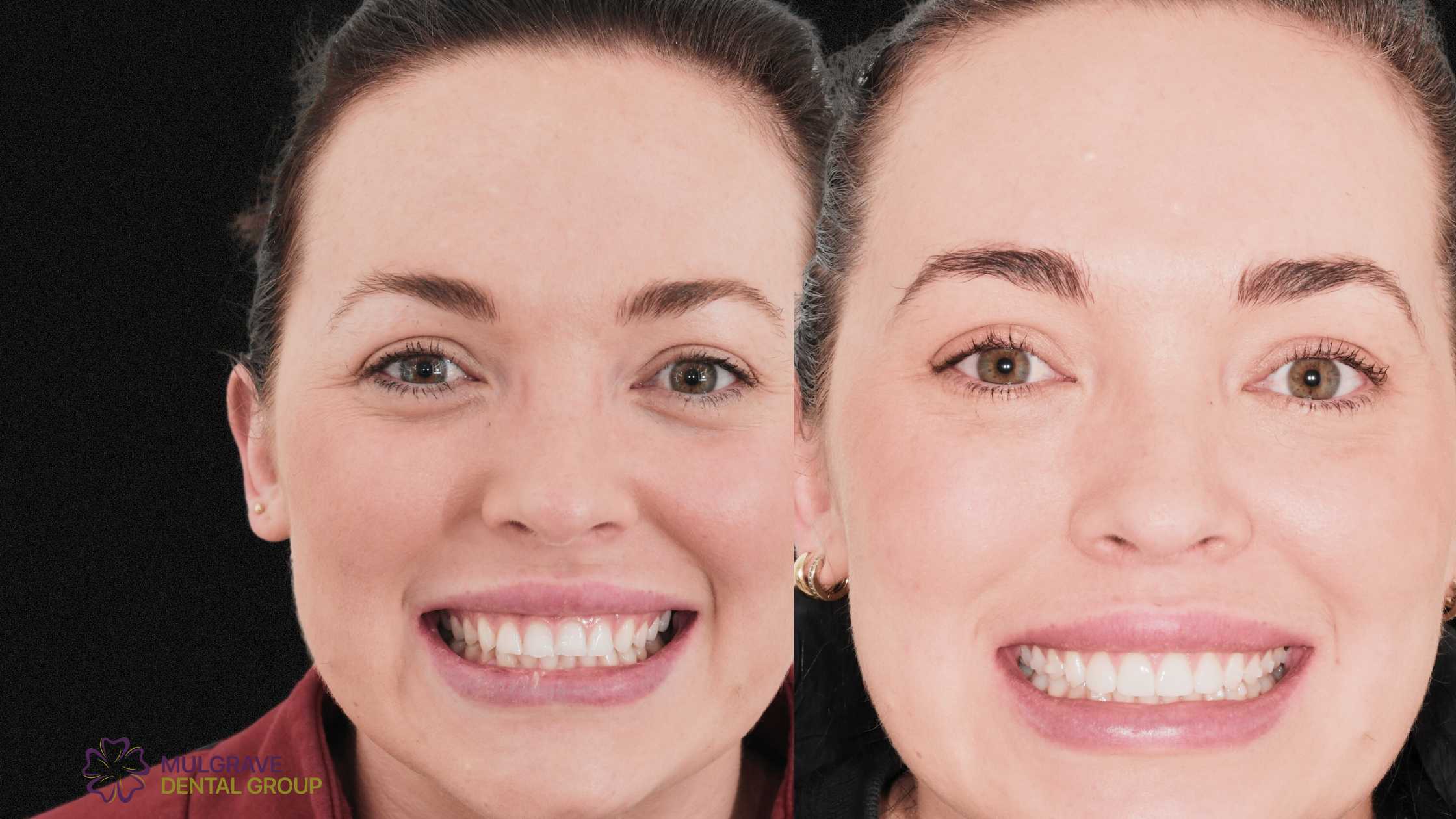 Veneers Smile Transformation in Melbourne