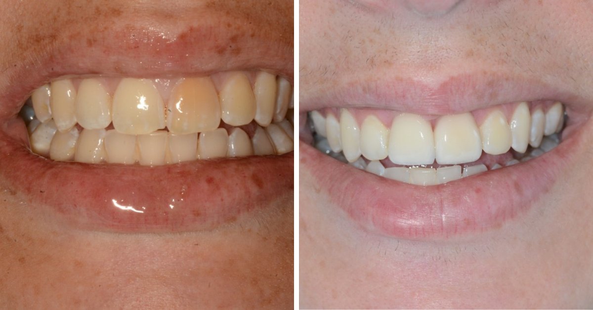 Dental Venners Mulgrave 1 Dental Venners Mulgrave 1