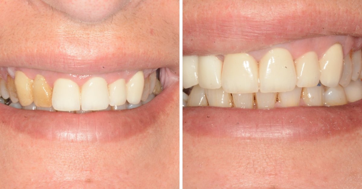 Dental Venners Mulgrave Dental Venners Mulgrave