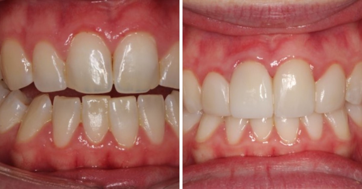 Dental Venners Mulgrave Dental Venners Mulgrave