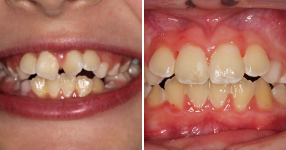 Before & After - Clear Aligners Adults