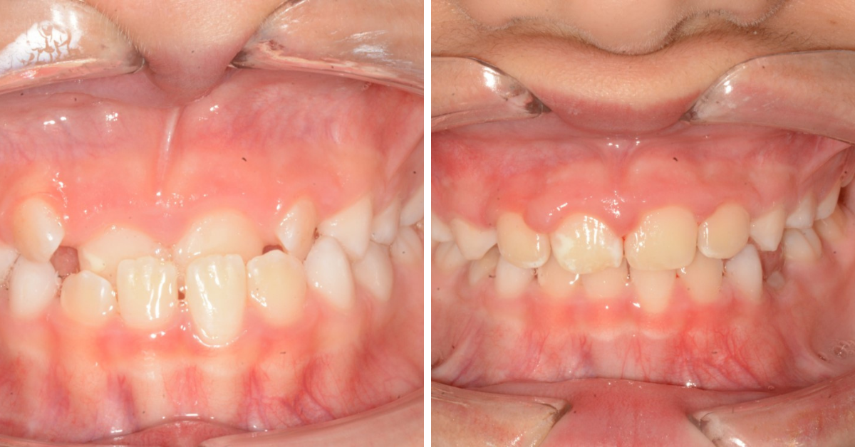 Before & After - Invisalign Adults