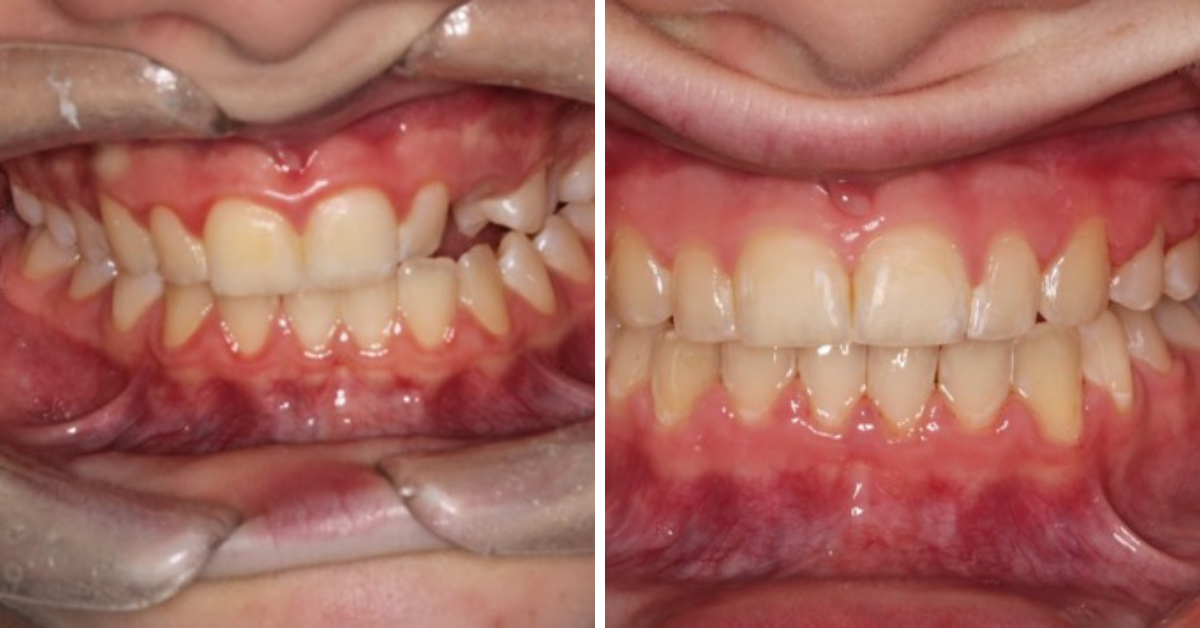 Before & After - Orthodontics Adults