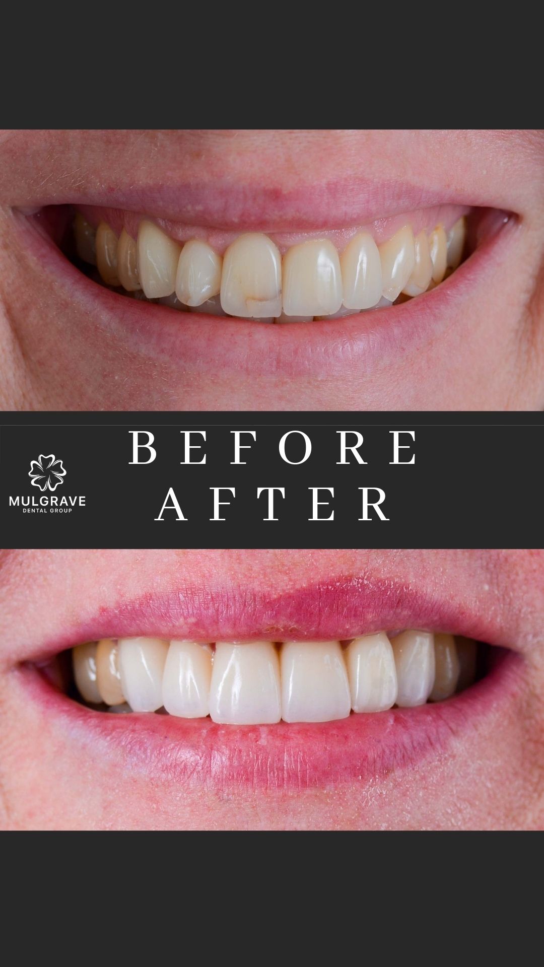 MDG Veneers Before and After RUT001