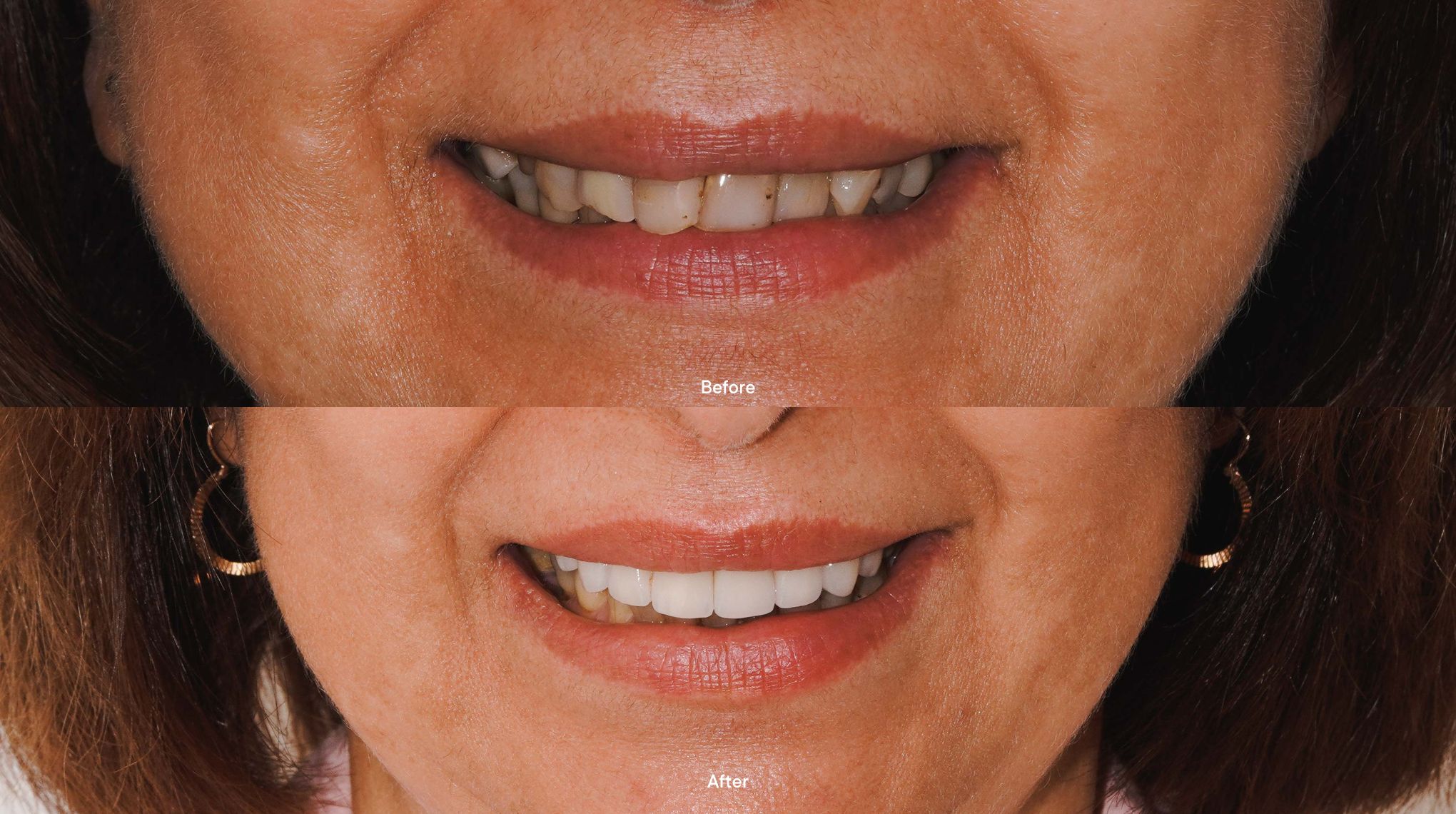 Patient Melbourne Veneers Before and AfterMG