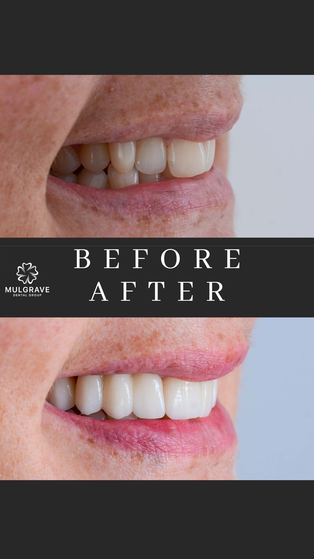 Melbourne Veneers Before and After VIC002