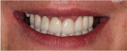 Patient's Teeth After Veneers and Crowns - Mulgrave Dental Group