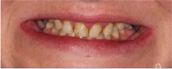 Teeth Before Veneers and Crowns - Mulgrave Dental Group